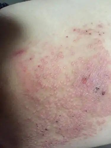 弟弟的大腿根部内侧长了小红疙瘩,很痒,越挠越多,连成一片啦～是什么