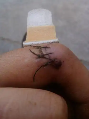 看下我的手该拆线了没?发现线长在上面了,怎么办呀?