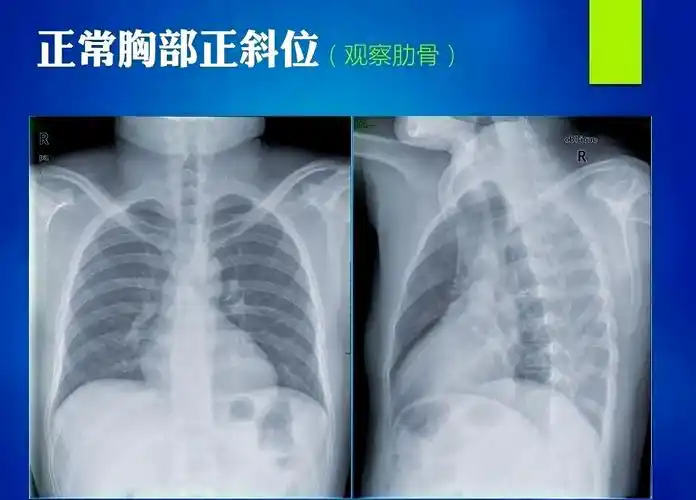 众多典型胸片,助你提升临床观察能力