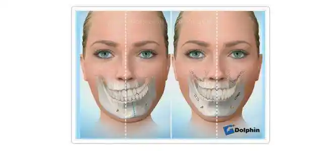 下颌骨和下颚骨有区别吗