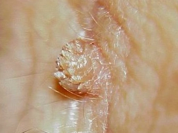 疣_疣症状表现 - 好大夫在线