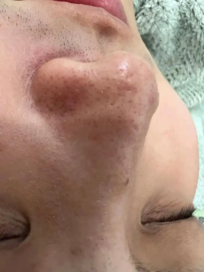 毛孔净化一次效果皮肤白皙一个度[嘿哈]        — - 抖音