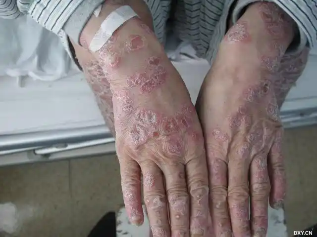 【共享】有关艾滋病的皮肤表现 - 皮肤与性传播疾病讨论版 -丁香园