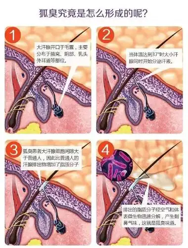 听说,冬季做微整形腋臭手术比较好哦