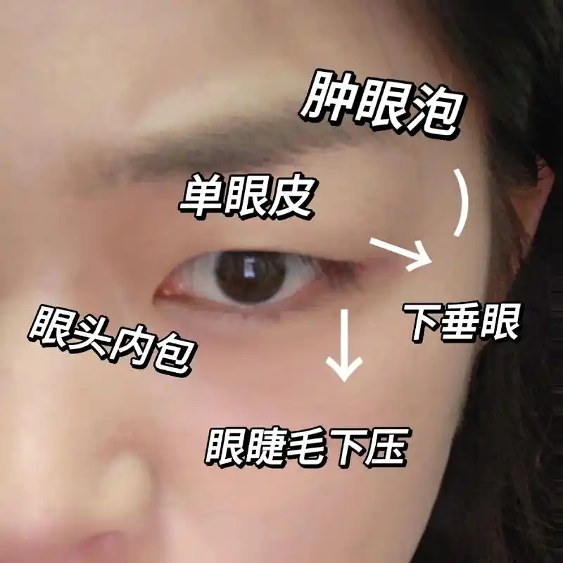 单眼皮 肿眼泡 下垂眼 睫毛下压 内眦赘.单眼皮 肿眼泡 下 - 抖音
