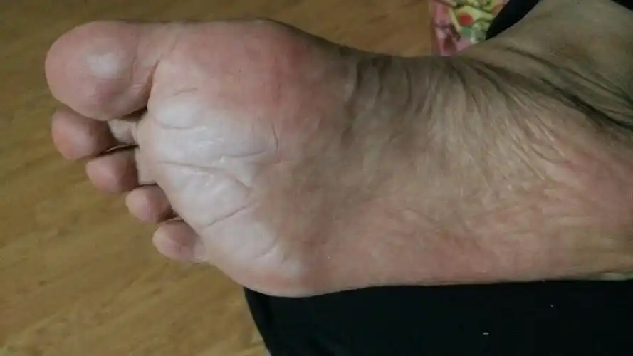 今天穿运动鞋,站了一天,脚底就泛白,跟水泡过了一样.