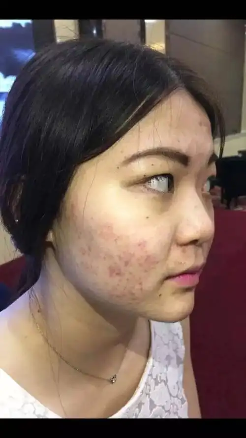 珠海这位20出头的女孩,如花的年龄,却因满脸痤疮,痘痘,使原本性格开朗