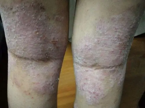 干燥脱皮瘙痒,特应性皮炎,拿什么来拯救你