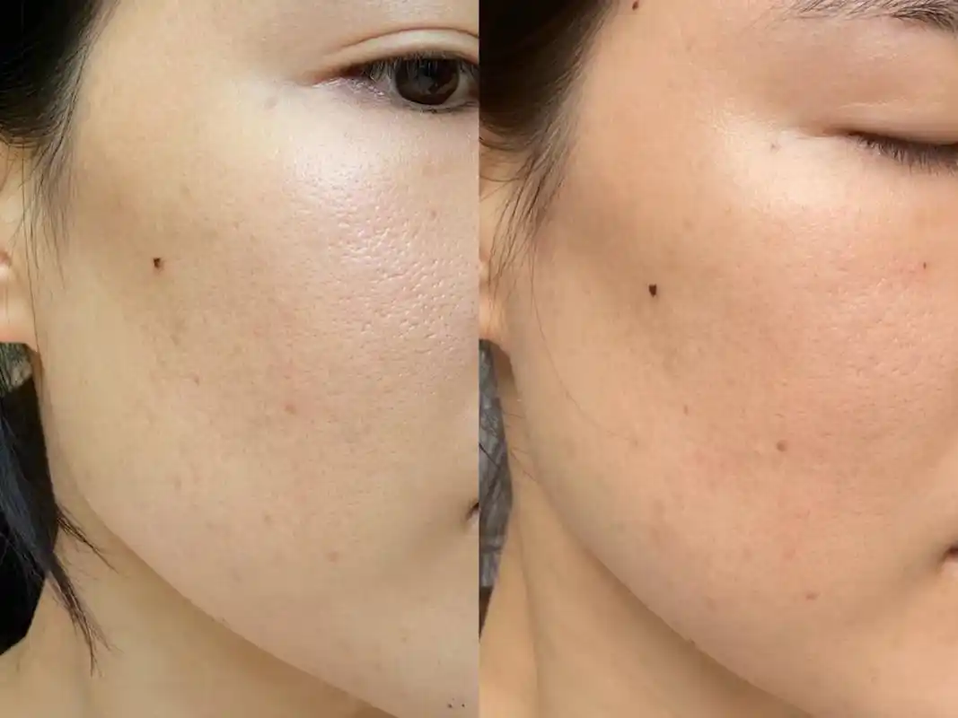 为何会毛孔粗大,毛孔粗大怎么办怎么收缩毛孔?