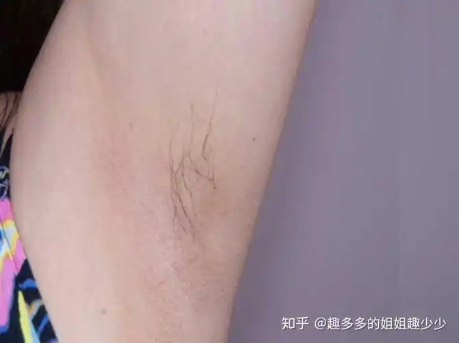 我的腋毛,比较少,前段时间刚脱过,不过真的长出来的毛毛变的细软