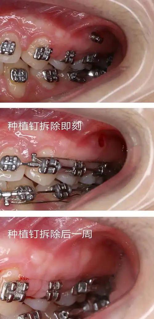 知者无畏,走近被冤枉的种植钉