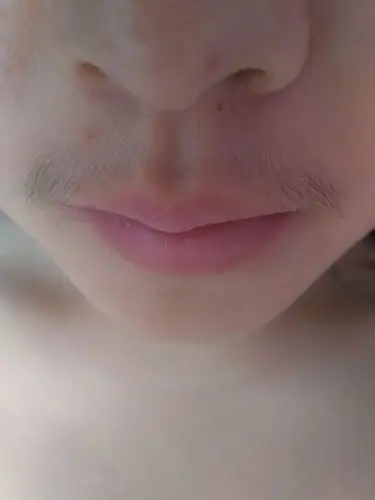 我是一个女生,今年20岁了,因为一直长有很浓的胡子所以一直很自卑