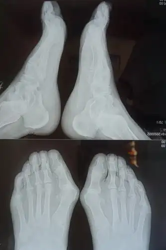 广济手足外科医院近期病例分享之:拇外翻