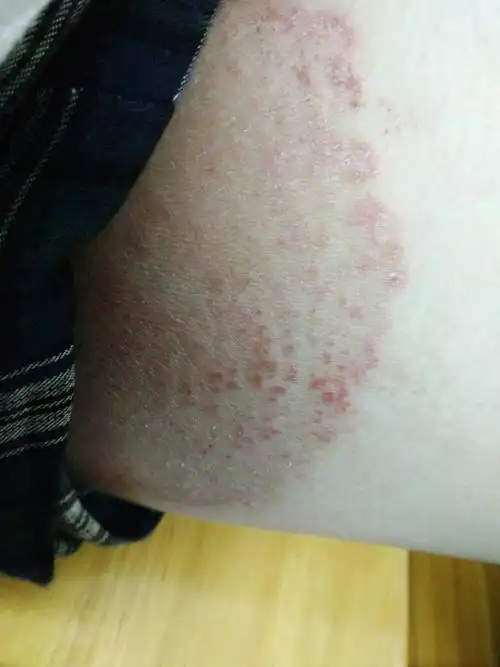 我是男性,大腿上这样是从去年开始的,很痒,有时候就突然很痒,我就抓