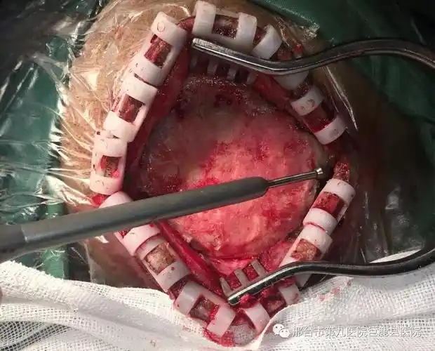 不一般的"头皮肿物"3例