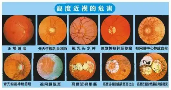 一名近视朋友的自述近视2000度是怎样一种体验图