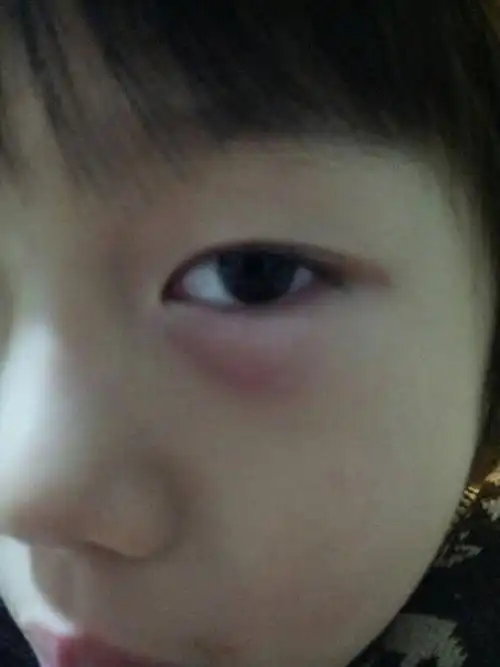 小孩左右眼袋上突然长了像蚊子叮的苞,有没有什么事,盼急复