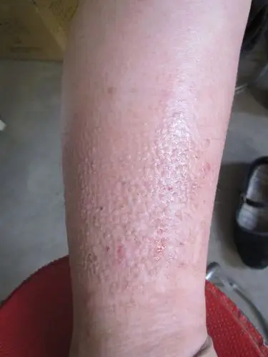 分享图片原发性皮肤淀粉样变