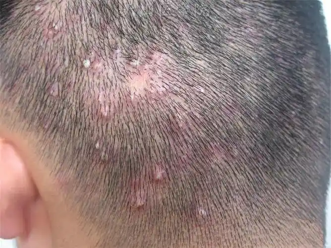 头皮,前胸后背长红疙瘩?当心是毛囊炎!