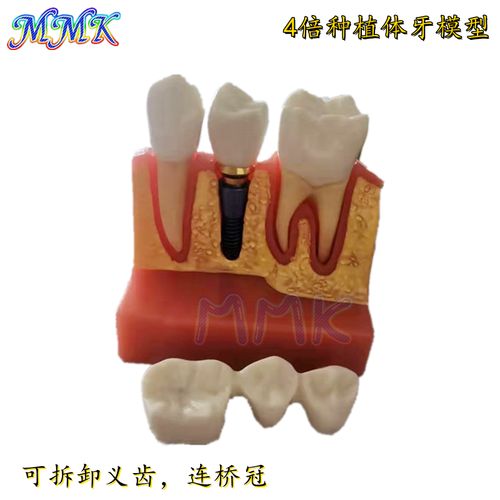 牙科材料4倍种植牙解说模型  连桥牙冠 可拆卸 种植钉 种植牙模型