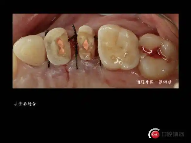 两颗双尖牙的死与生