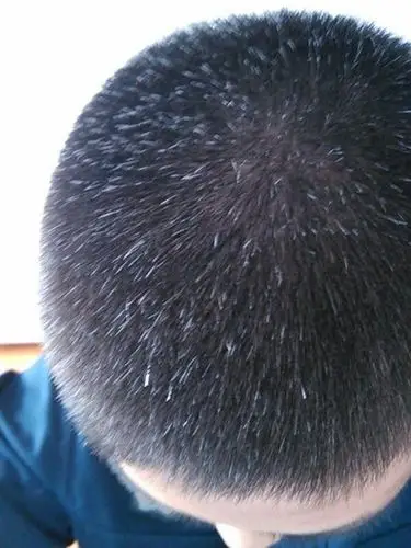 少年白是遗传还是早衰?年轻人长白头发要这样做