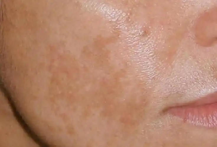 红霉素软膏,主要用于治疗患者的皮肤疾病,包括皮肤的炎症,皮肤的烫伤