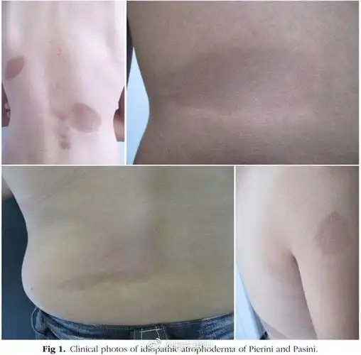 pasini-pierini皮肤萎缩.图源:jaad
