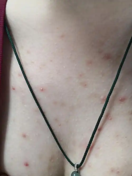 前胸后背散发红斑丘疹脓疱症状,是马拉色菌毛囊炎症状.