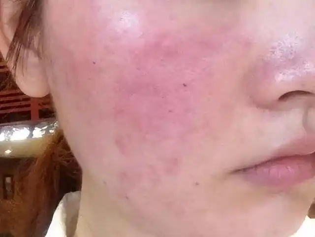 皮肤总是敏感脆弱或是跟日常5个操作有关很多人忽视了