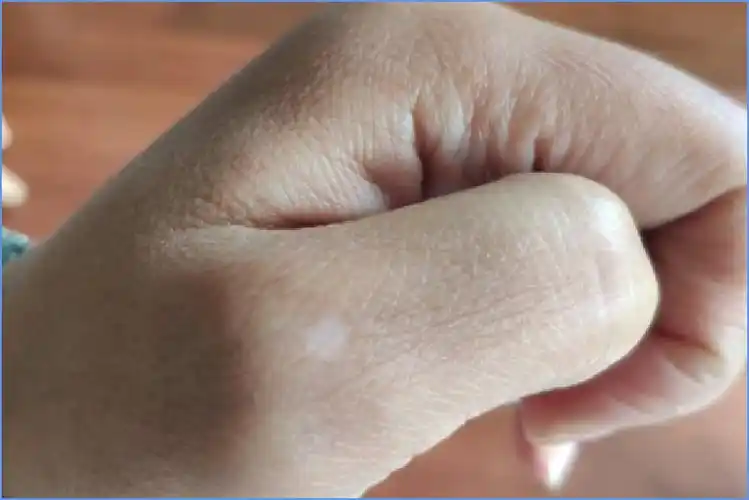 怎样防止白癜风扩散症状的出现