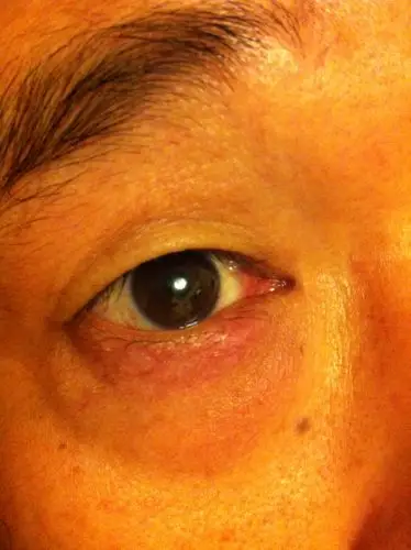 眼睛下面眼袋皮有红肿是怎么了,有点痛