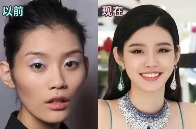 奚梦瑶整容了鼻头缩小面部填充明显戴着钻戒秀恩爱