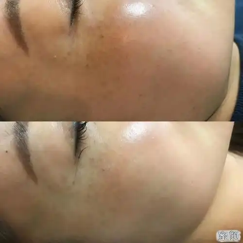 注射水光针之后,效果能够维持多久?注射水光针