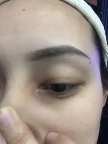 眼角长了一个小包 长了几年了 没看过医生 有人知道这是啥吗 不像脂肪