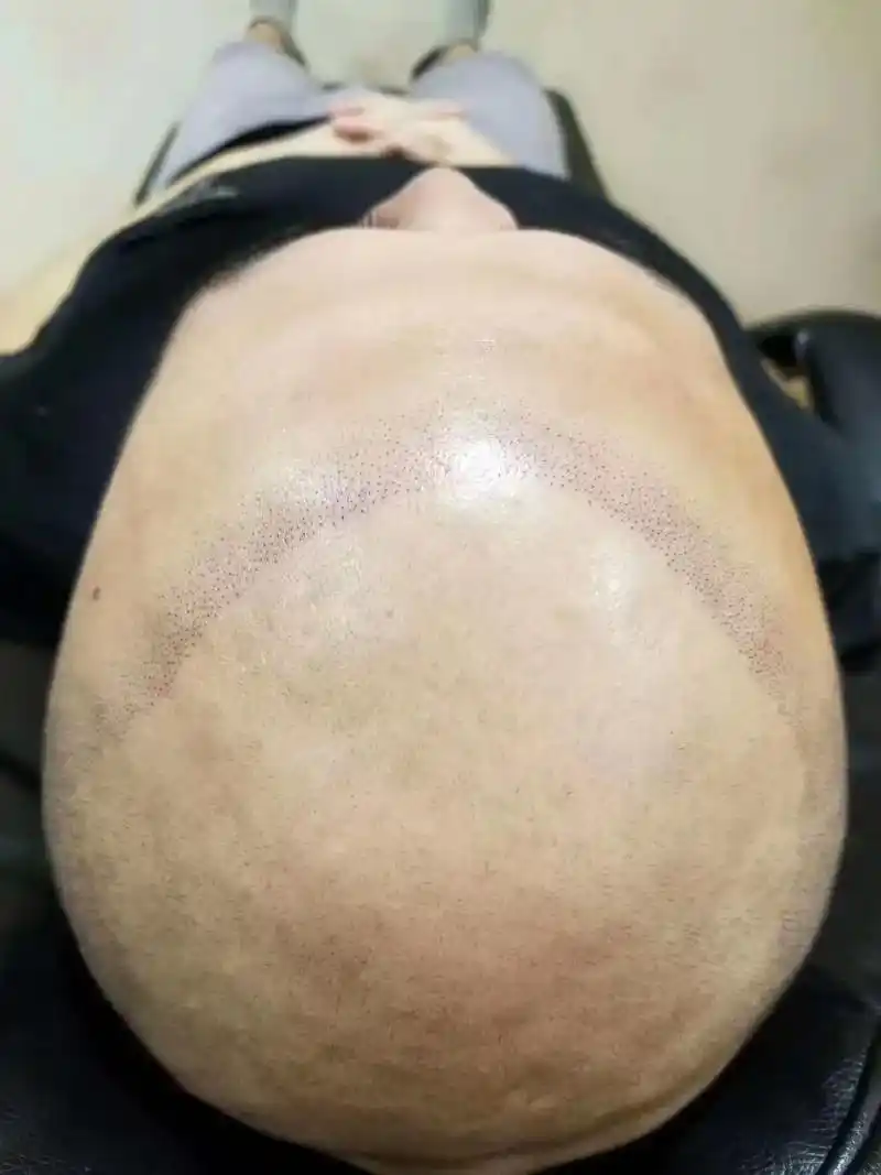 脂溢性掉发 #smp #smp头皮微色素着色 - 抖音