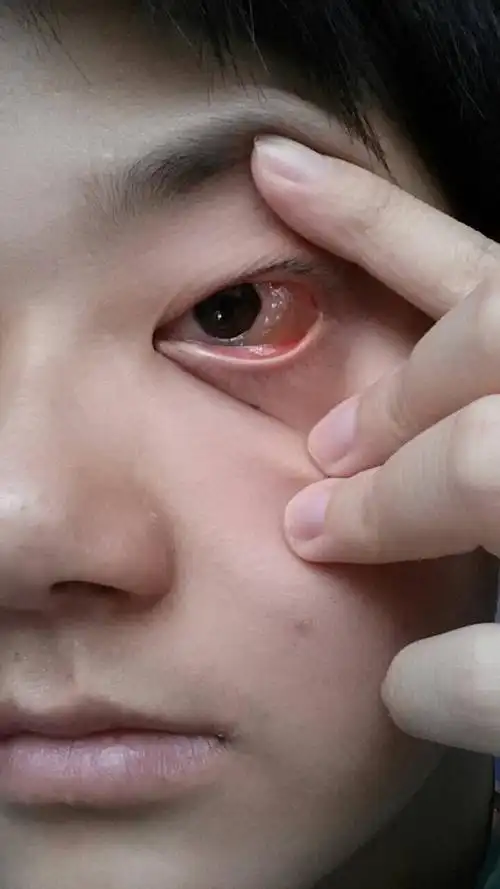 睡午觉的时候揉了眼睛两下,以为一觉起来会好的,结果变成了这种像水泡