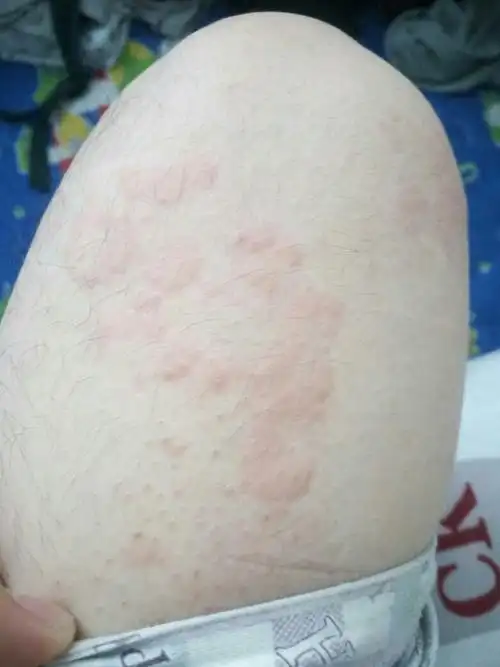 前两天去医院医生说是荨麻疹 开了抗过敏的药 但现