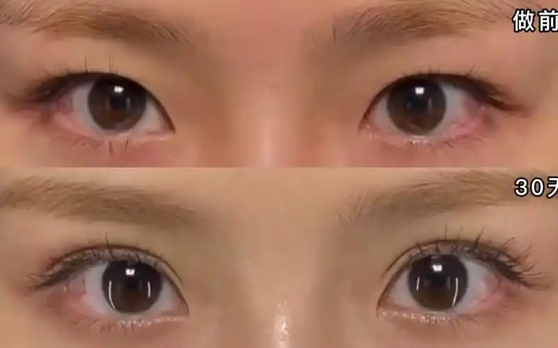 6mm平行型双眼皮,30天闭眼无痕!