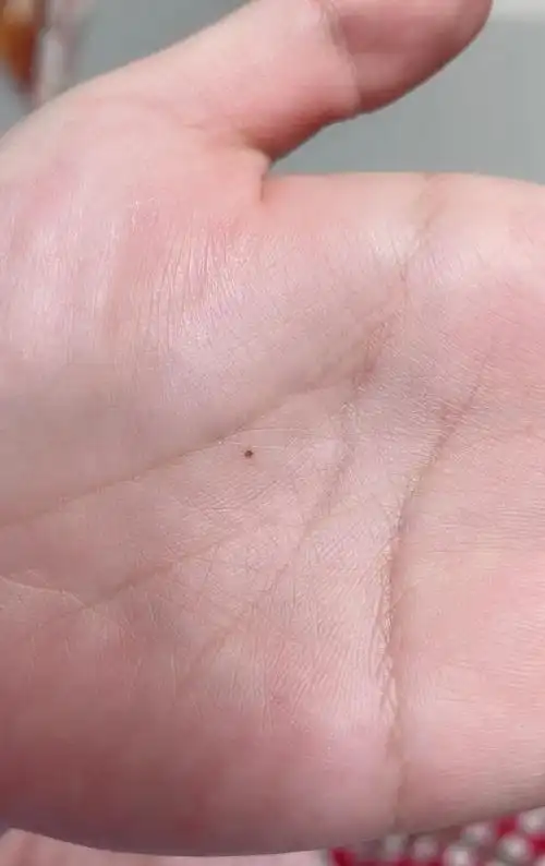 手心里突然长了一颗小痣代表什么? - 知乎