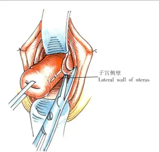 非脱垂子宫阴式全子宫切除术