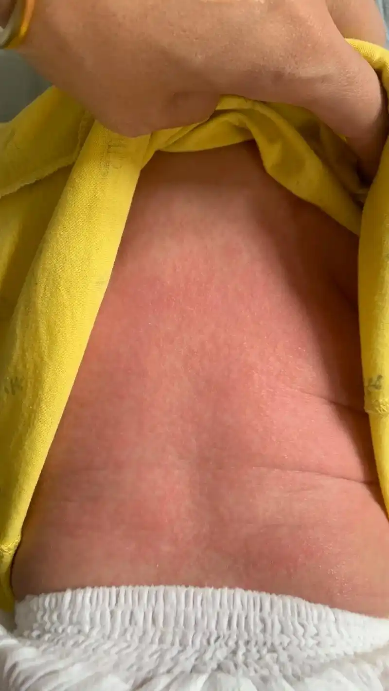 湿疹的尽头到底是什么呢?心好累,每天夜里大人孩子一起熬～#大 - 抖音