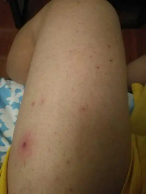 腿上总是长红痘痘,类似火疖子,怎么治疗