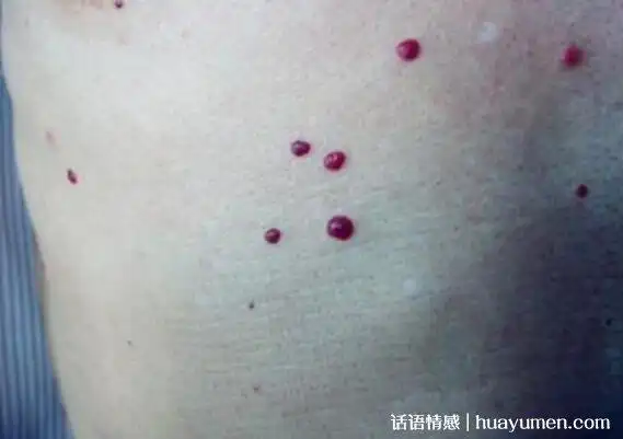 红痣与朱砂痣区别图片(红痣与朱砂痣是什么意思)