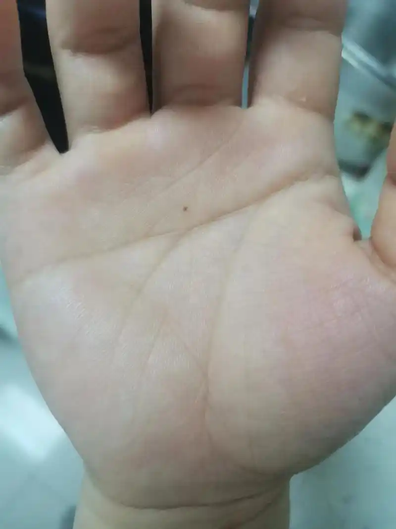 痣和手掌纹路会变.