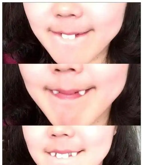 一闭可以露出两个大门牙,看着就像小兔子的感觉,再换一个是一对小虎牙