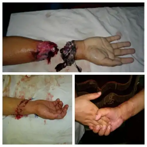 长航东院手足显微外科主任张芝亮在断肢(指)再植,拇手指再造等方面有