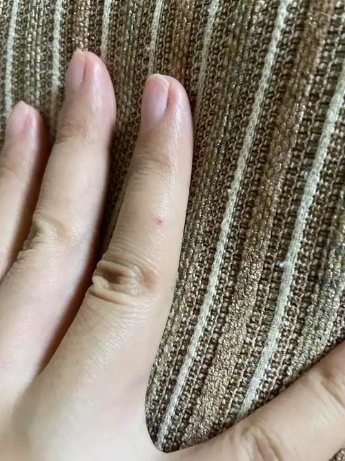 手上长了一颗红色的痣