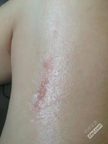 大腿被开水烫伤起泡了怎么处理才不会留疤痕阿急急急