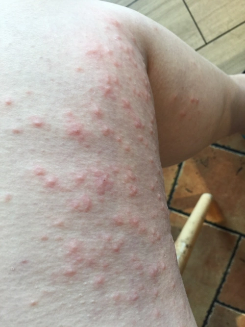 痒痒痒!怀孕31周,起了很多疹子